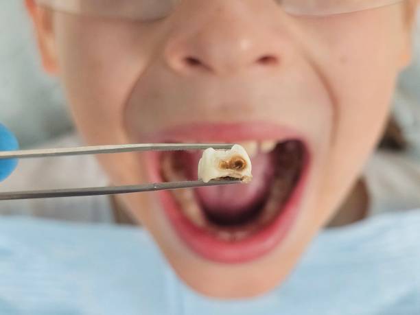 Best Emergency Tooth Extraction in Edgewood, TX